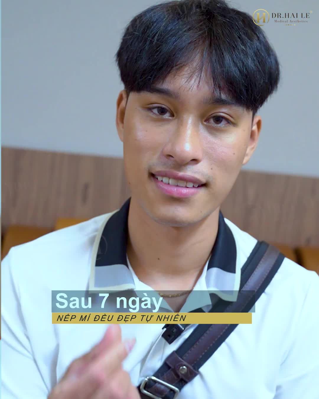 24 năm sống trong mặc cảm, tự ti, ngại giao tiếp, ngại gặp gỡ bạn bè, từ bỏ mọi cơ hội......chỉ vì đôi mắt sụp mí bẩm sinh - nhưng đó là câu chuyện của quá khứ.