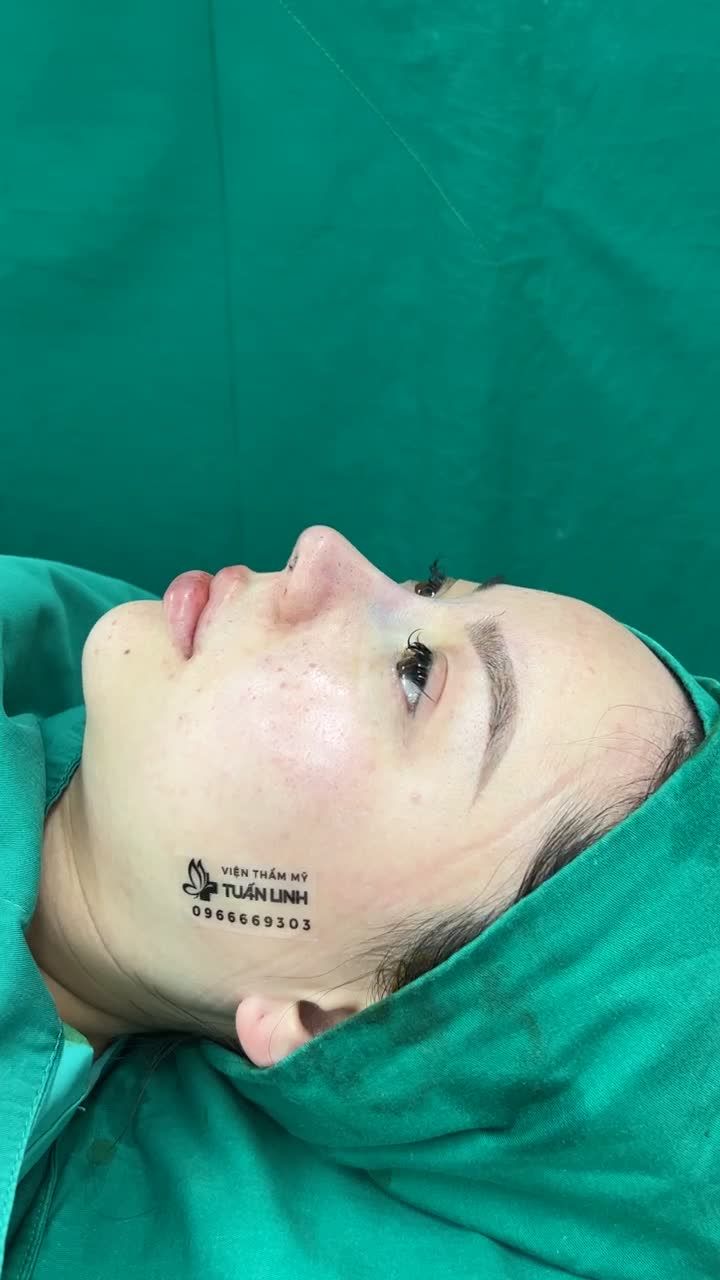 Lựa chọn sụn Surgiform cho nền tảng mũi có da mỏng và lên dáng mũi đẹp tự nhiên bằng phương pháp nâng mũi cấu trúc Surgiform!!!