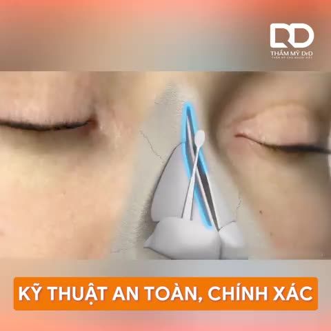 SỐNG MŨI CAO NHƯNG BỊ GỒ THÔ CỨNG KHẮC PHỤC THẾ NÀO