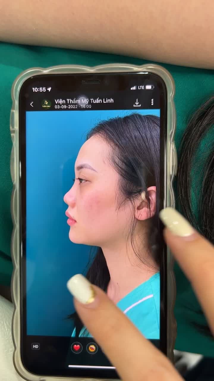 THAY ĐỔI 200% SAU NÂNG MŨI SIÊU CẤU TRÚC Dáng mũi sau 10 ngày tháo nẹp!!!