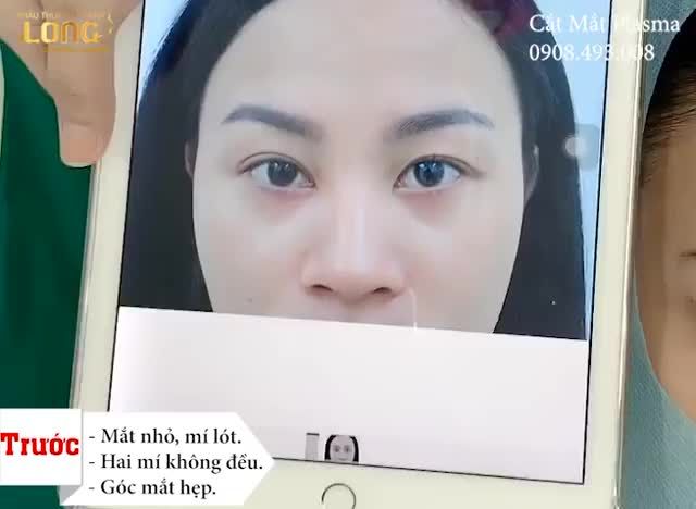 Đôi mắt chưa đủ đẹp chỉ vì 4 nguyên nhân trên. KHẮC PHỤC GẤP THÔI