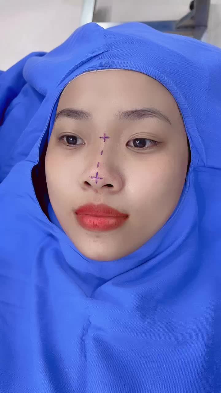 Quá trình bác sĩ phân tích combo Cắt mí 6D - Nâng mũi 6D Surgiform