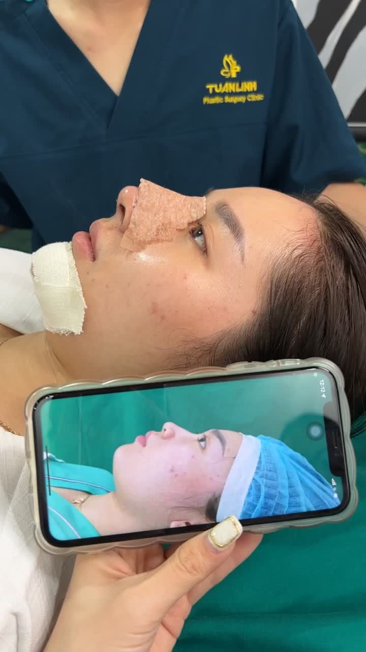 THAY ĐỔI BẤT NGỜ VỚI COMBO NÂNG MŨI + ĐỘN CẰM SAU 5 NGÀY THAY NẸP