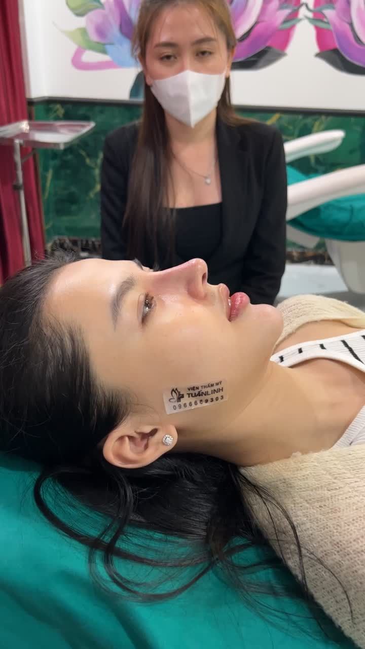 Khách hàng thực hiện nâng mũi siêu cấu trúc sụn Surgiform.