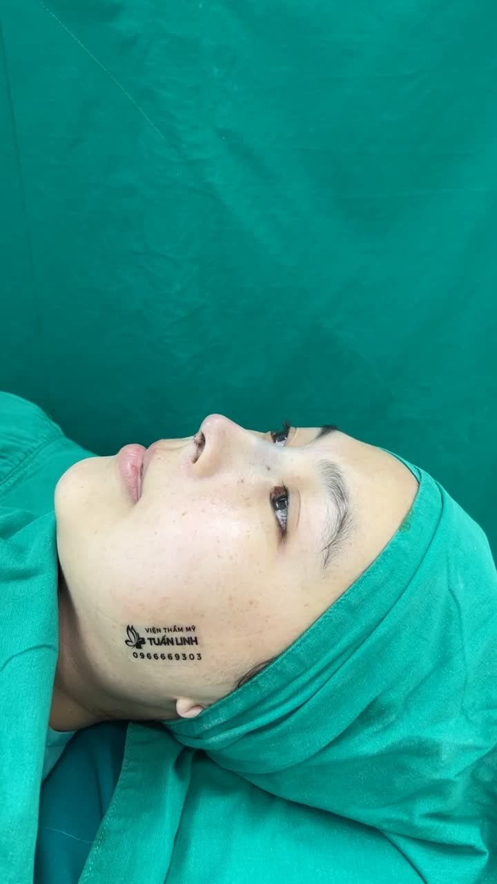 SỞ HỮU DÁNG MŨI THANH TÚ VỚI NÂNG MŨI CẤU TRÚC SURGIFORM