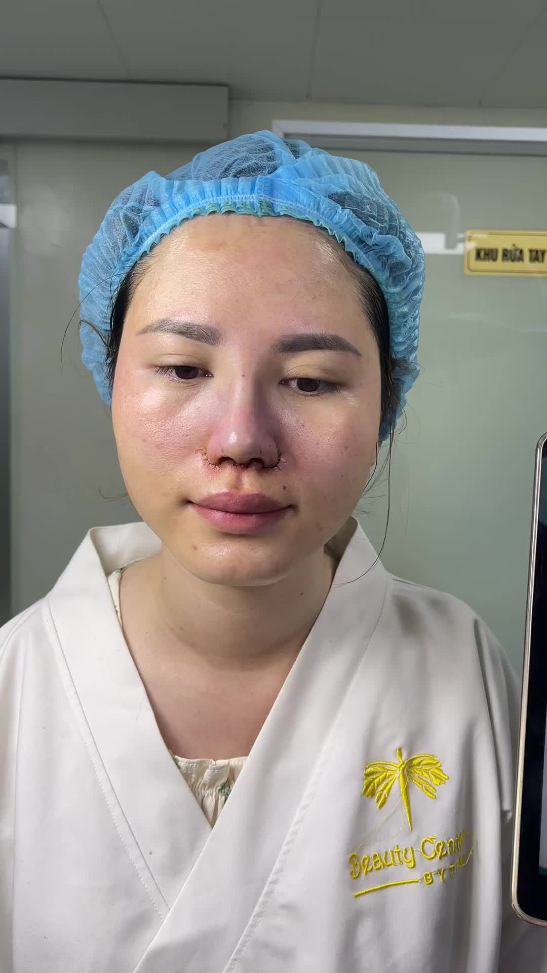 Kết quả nâng mũi kết hợp thu nền mũi và cánh mũi cho khách hàng