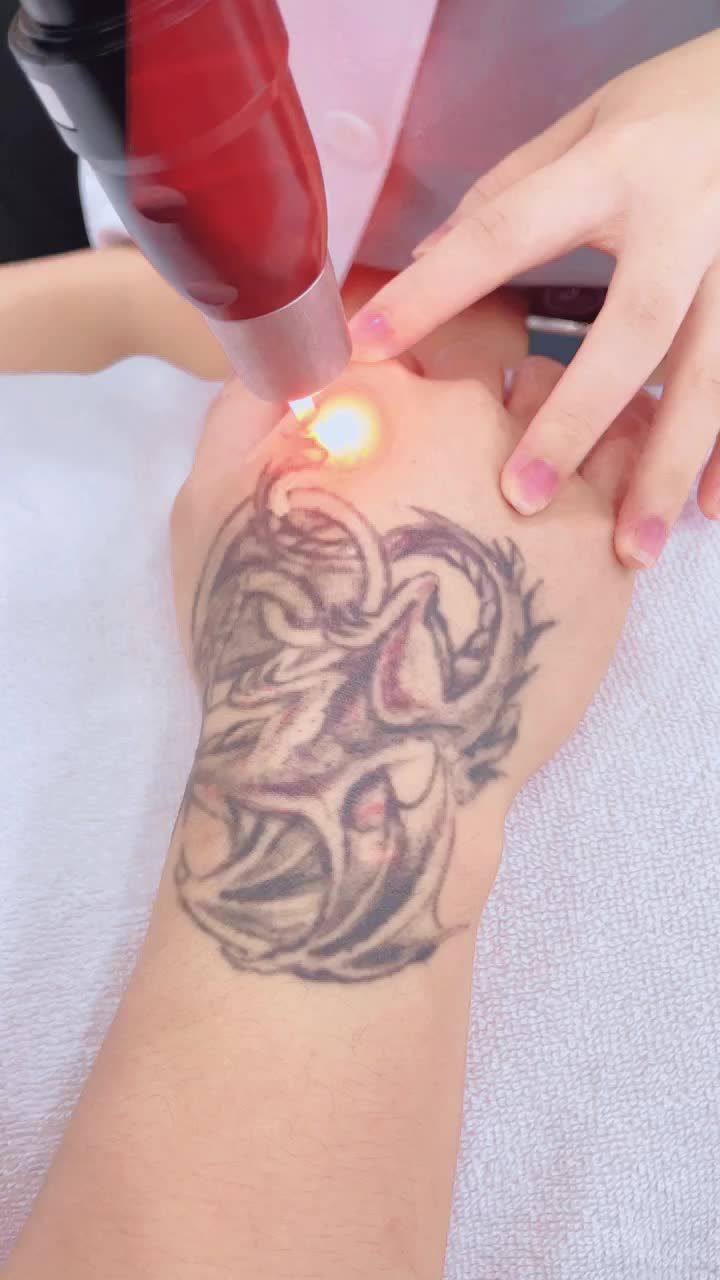 quy trình xóa xăm bằng công nghệ Laser Picosure tại BVTM Kangnam