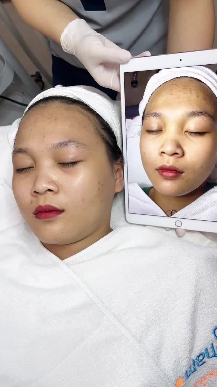 Công nghệ điều trị mụn De-acne tại Kangnam  Cùng xem quy trình thực hiện buồi 3 của khách hàng nữ tại Kangnam Hà Nội nhé!