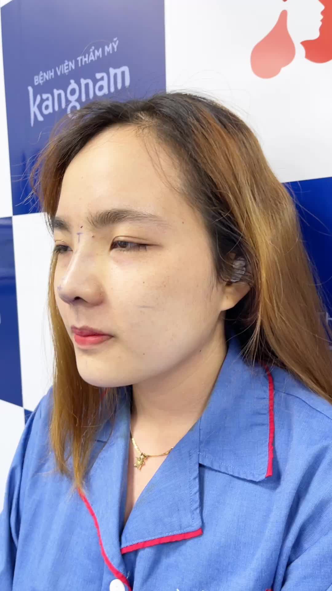 Thay đổi bất ngờ cùng dịch vụ Nâng mũi sline tại Kangnam