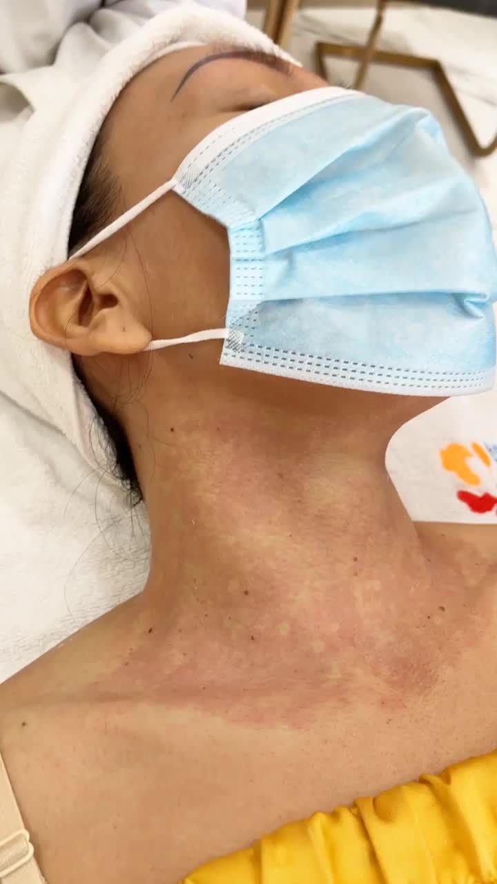 Điều trị mụn thịt hiệu quả tại Kangnam với công nghệ Laser thế hệ mới
