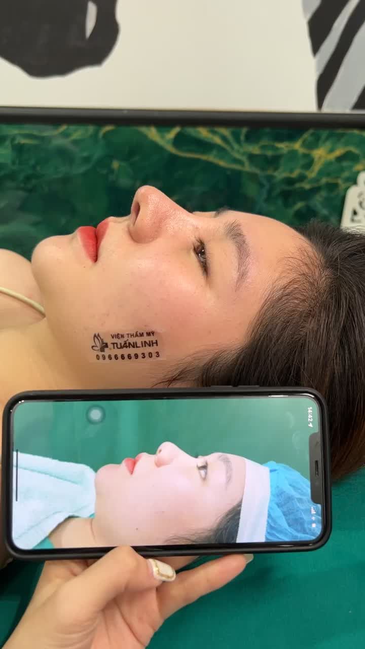 SỞ HỮU CHIẾC MŨI CỰC PHẨM CHỈ SAU 10 NGÀY VỚI NÂNG MŨI CẤU TRÚC, TIN ĐƯỢC KHÔNG