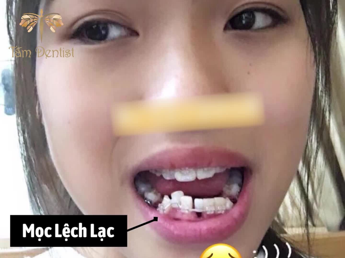 Tại sao Niềng răng mắc cài kim loại tại Tấm Dentist lại được rất nhiều khách hàng tin tưởng lựa chọn