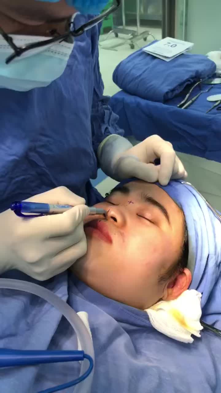 Quy trình đo vẽ dịch vụ Nâng mũi Cấu trúc 4D như thế nào