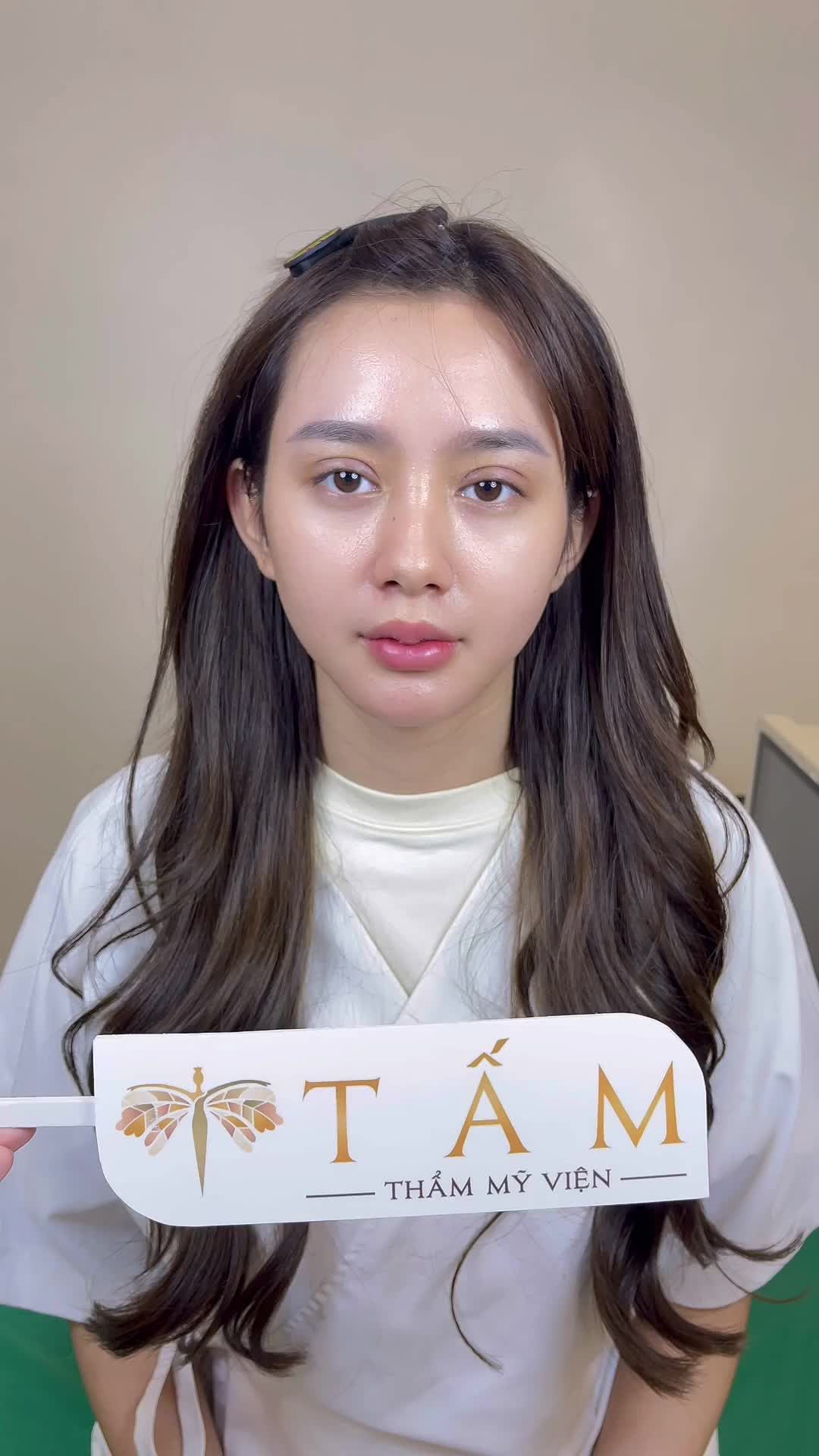 Khách hàng đến thăm khám sau 6 ngày thực hiện Cắt mí + cắt môi trên tại Tấm.