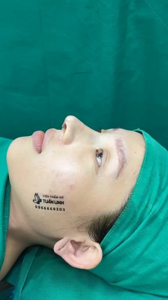 Case nâng mũi Siêu cấu trúc sụn #Surgiform cho khách hàng đã từng tiêm filler trước đó!!