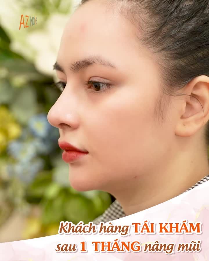 Dáng mũi 1 tháng tuổi thực hiện bởi Bác sĩ Hoàng Nhung