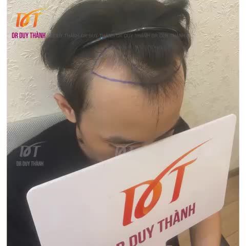 Ngày mưa gió trả video cấy 1200 nang tóc (cách đây 2 hôm) mời anh em cùng chiêm ngưỡng thành quả của bác sĩ và ekip.