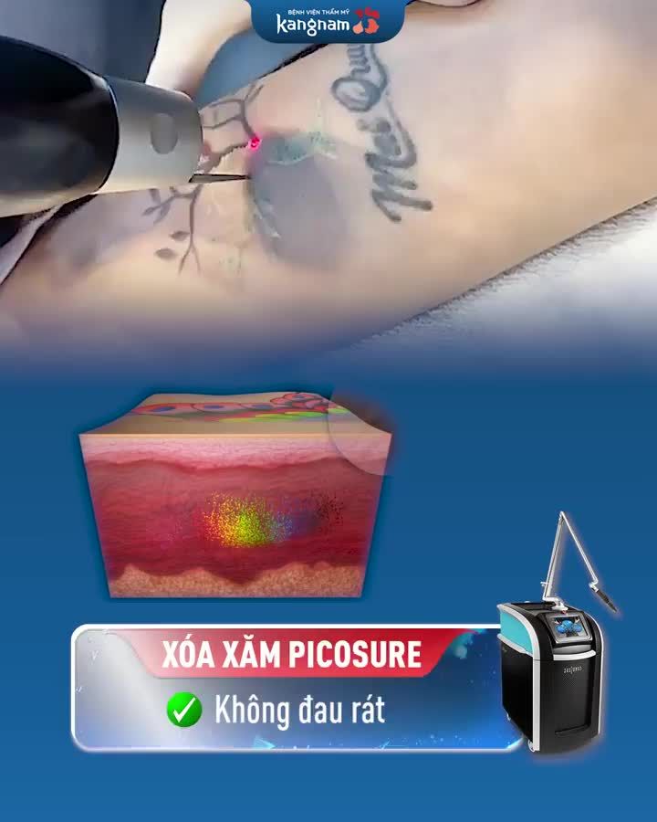 Xóa Xăm công nghệ cao  -35%   từ 1.95tr