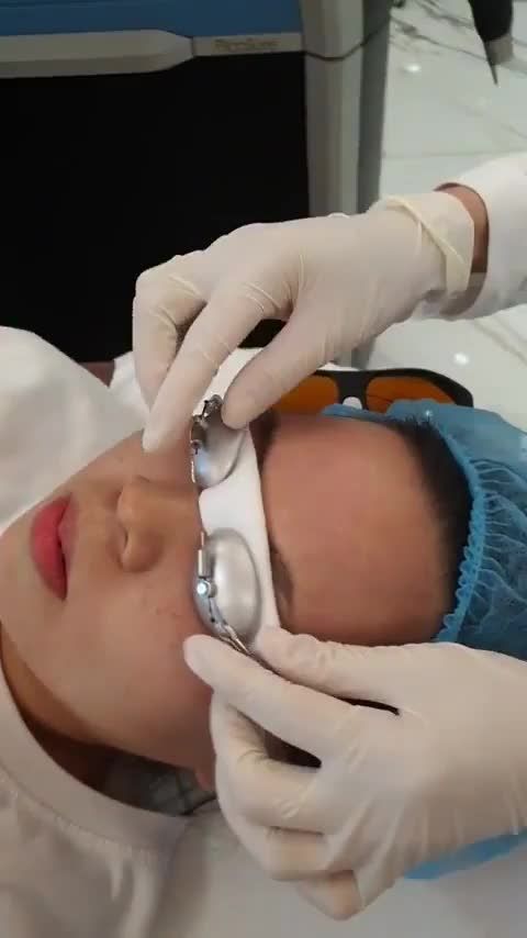 Cận cảnh bông tuyết ngay sau khi Điều trị tàn nhang của Laser Picosure
