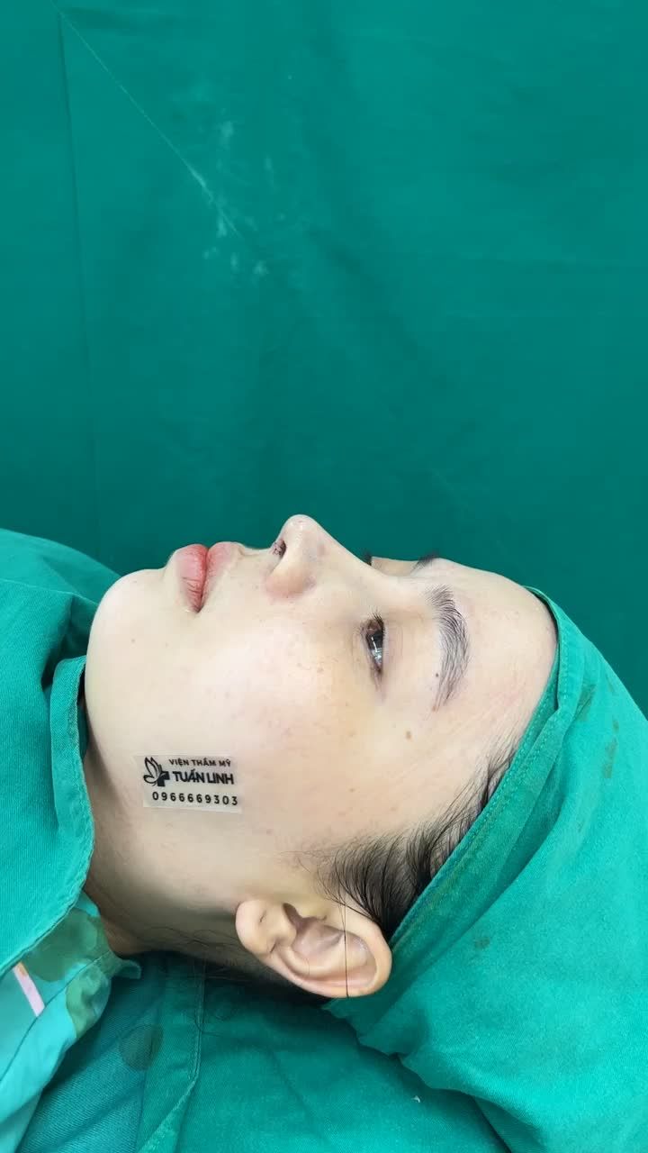 NÂNG MŨI CẤU TRÚC HOÀN THÀNH SAU 90 PHÚT