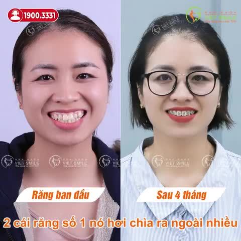 30 TUỔI NIỀNG RĂNG CẢI THIỆN KHẤP KHỂNH CÓ MUỘN KHÔNG