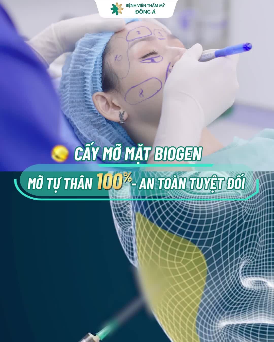 Lấp đầy hốc hác - Trẻ hóa 10 tuổi gương mặt