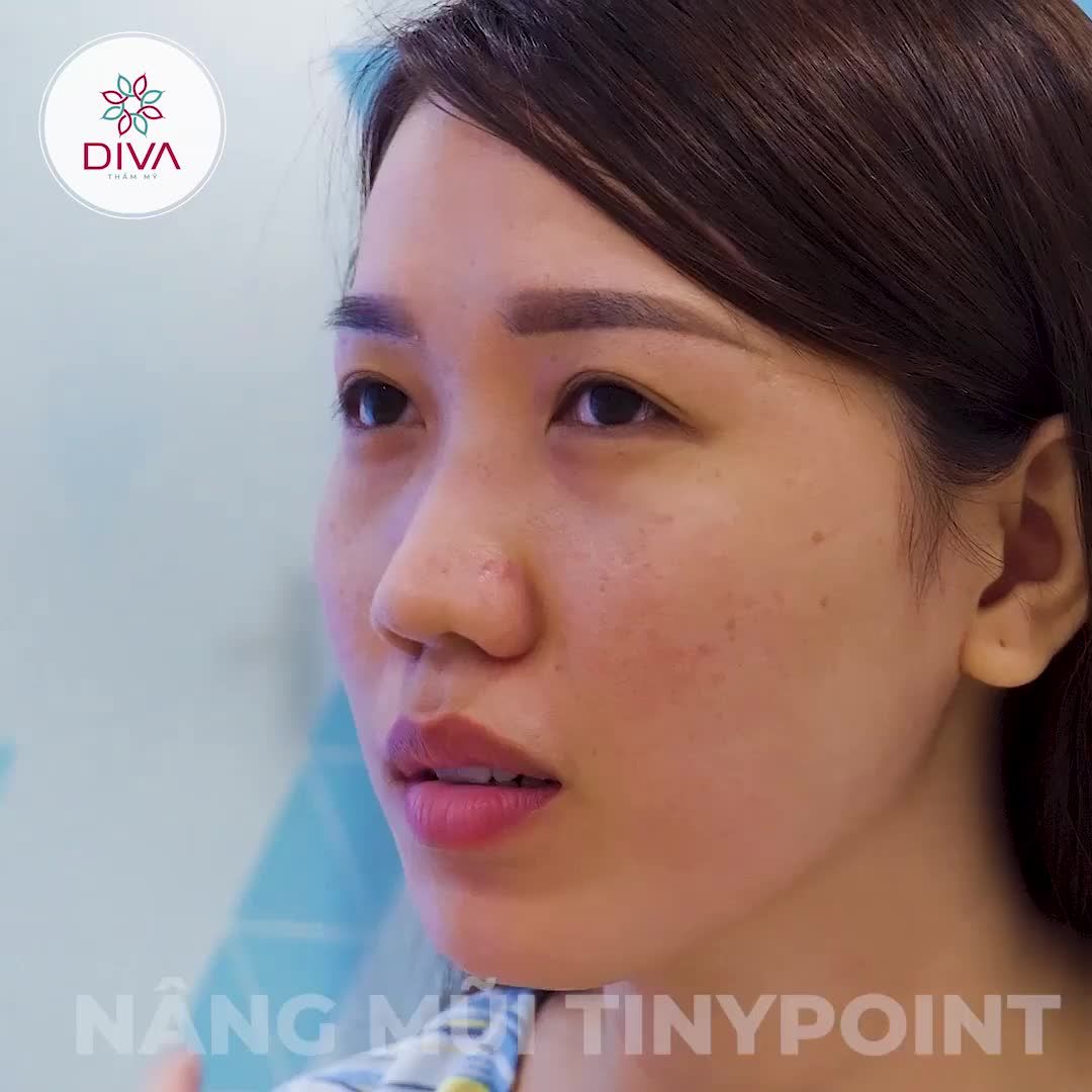 KẾT QUẢ SAU NÂNG MŨI, CẤY MỠ, LẤY MỠ MÍ DƯỚI CỦA MINH THƯ NHƯ THẾ NÀO