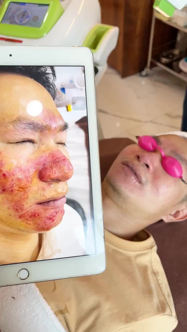 Bất ngờ với sự thay đổi ngoạn mục với công nghệ điều trị mụn Deacne Tại kangnam hết mụn viêm hiệu quả
