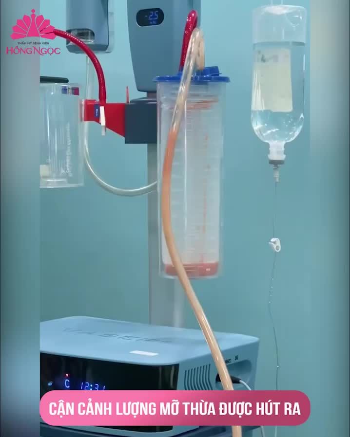 MỠ THỪA Ở ĐÂU - VASER LIPO HÚT NGAY Ở ĐÓ