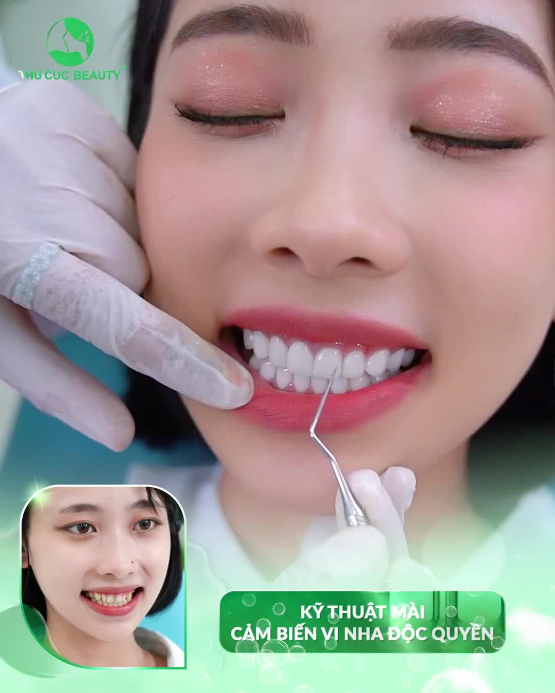 Cận cảnh tái khám răng sứ TC sau 3 tháng