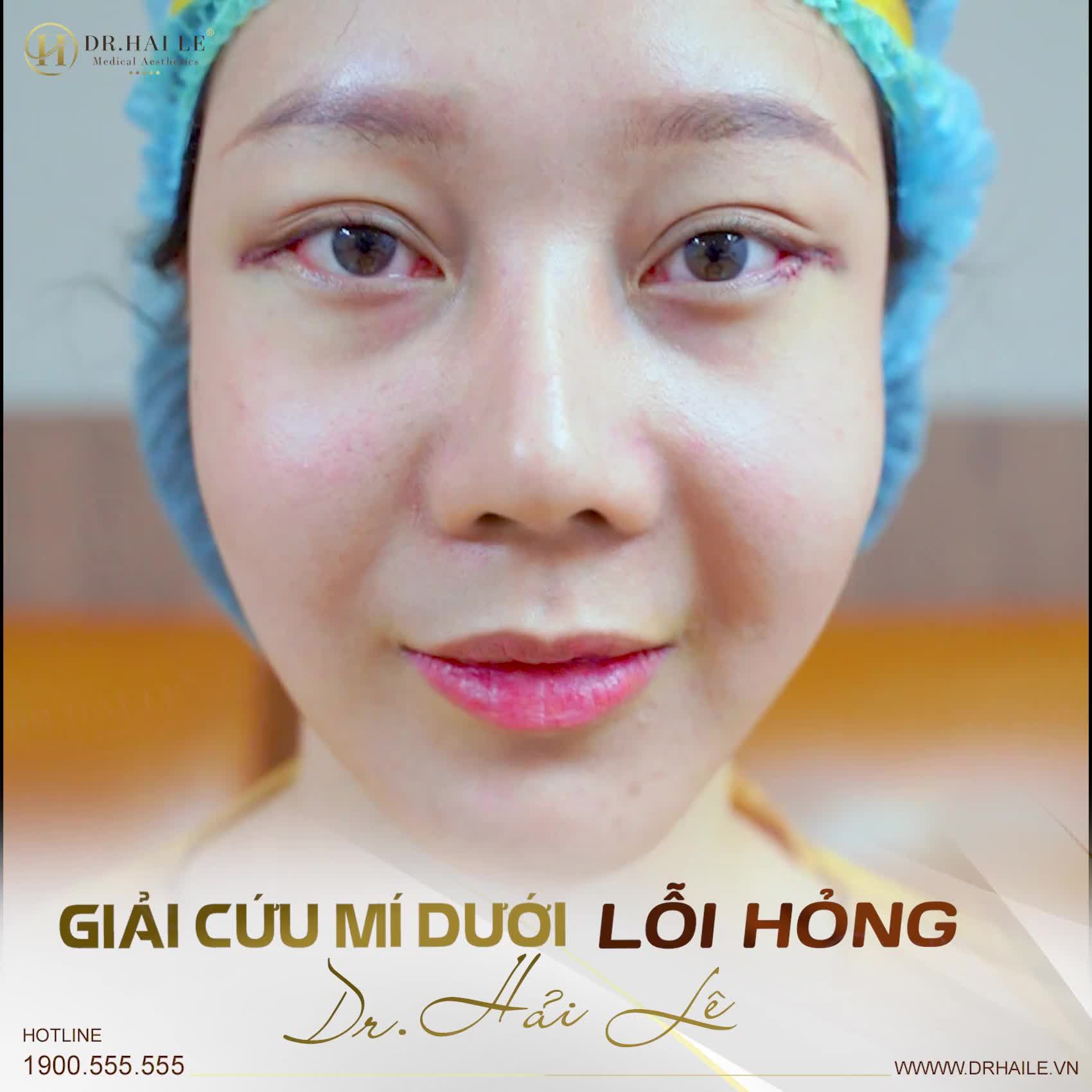 Dr.Hải Lê giải cứu mọi ca mí lỗi hỏng Trên Dưới