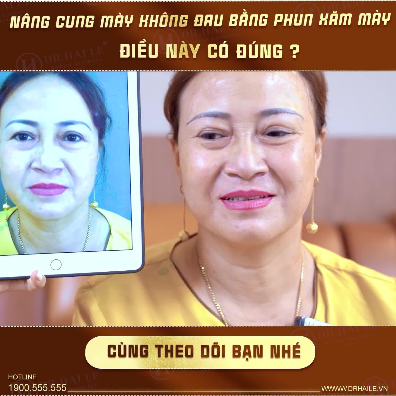 Nâng cung mày, giải pháp vàng giúp đôi mắt của chị em phụ nữ tuổi trung niên luôn trẻ trung rạng rỡ