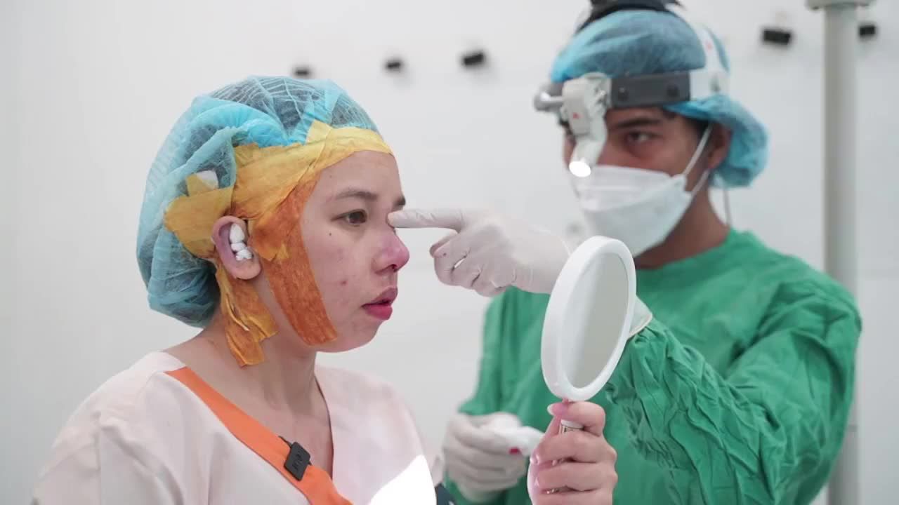 Ca nâng mũi cấu trúc sụn tai