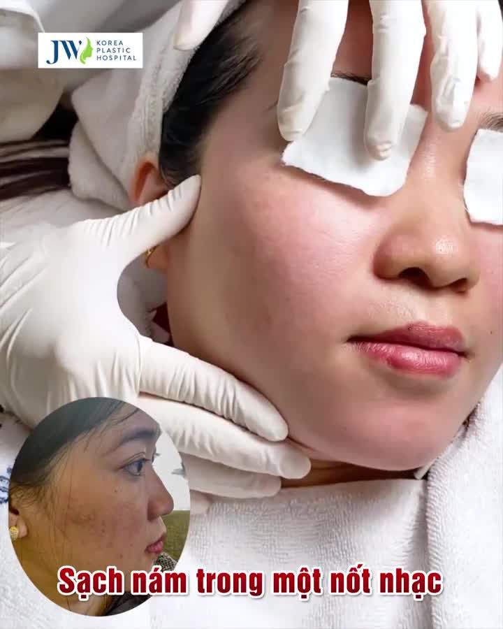 ĐIỀU TRỊ SẠCH NÁM, TÀN NHANG - CĂNG MỊN, TRẮNG SÁNG