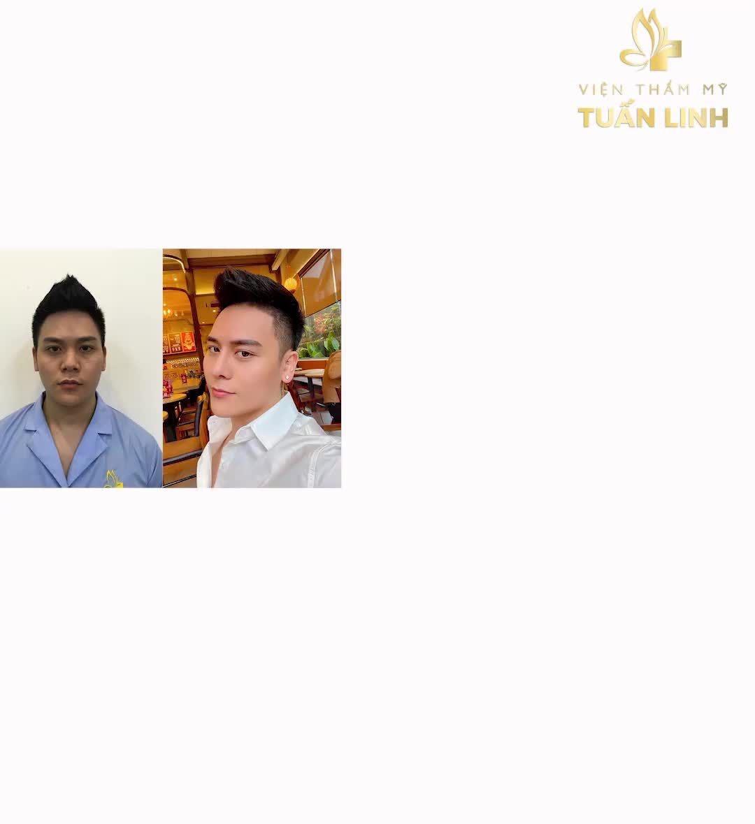 ĐIỂM DANH NHỮNG YẾU TỐ LÀM NÊN THƯƠNG HIỆU NÂNG MŨI TẠI TUẤN LINH!!!