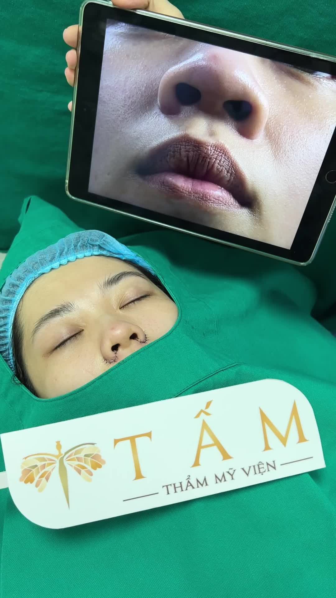 Kết quả ngay sau làm ca thu gọn cánh mũi cho khách hàng