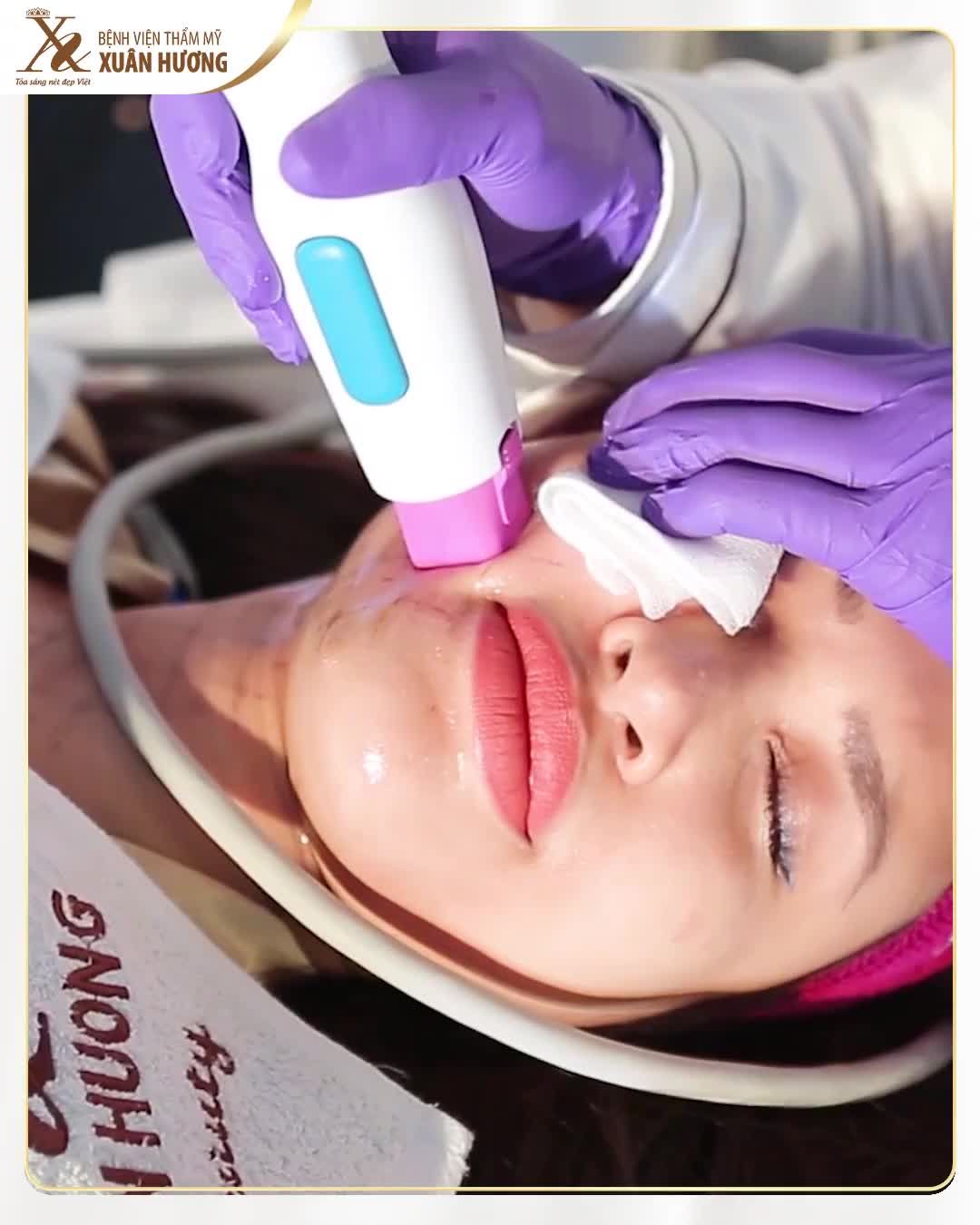 LÀN DA LÃO HÓA ĐÃ BỊ THERMAGE 4.0 ĐÁNH BẠI HOÀN TOÀN, LẤY LẠI THANH XUÂN CHO GƯƠNG MẶT