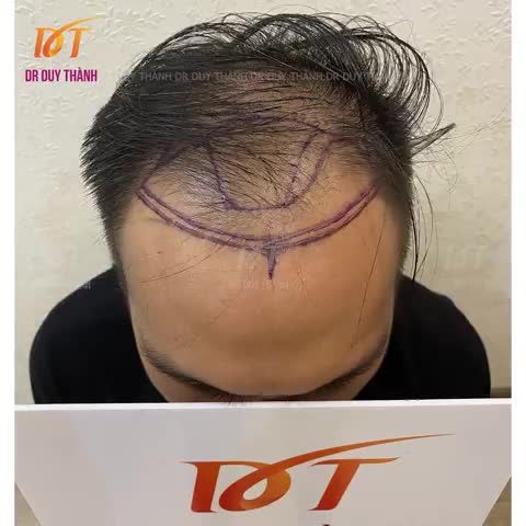 NGẮM TÁC PHẨM 2000 NANG TÓC TRƯỚC VÀ SAU KHI CẤY- KHÁCH TP.HCM.