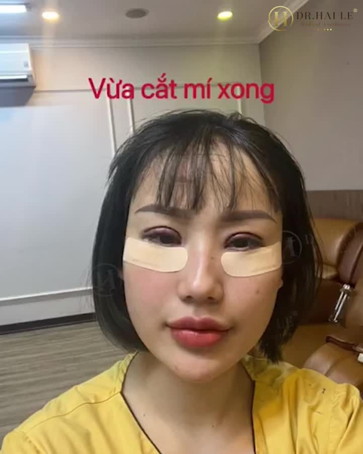 Thay đổi gương mặt với từ 0 ngày - 7 ngày làm combo mí trên + mí dưới như thế nào