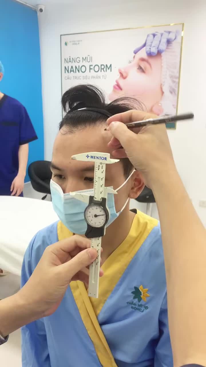 Thiết kế đường Line tóc cho KH cấy tóc tự thân - điều trị hói chữ M