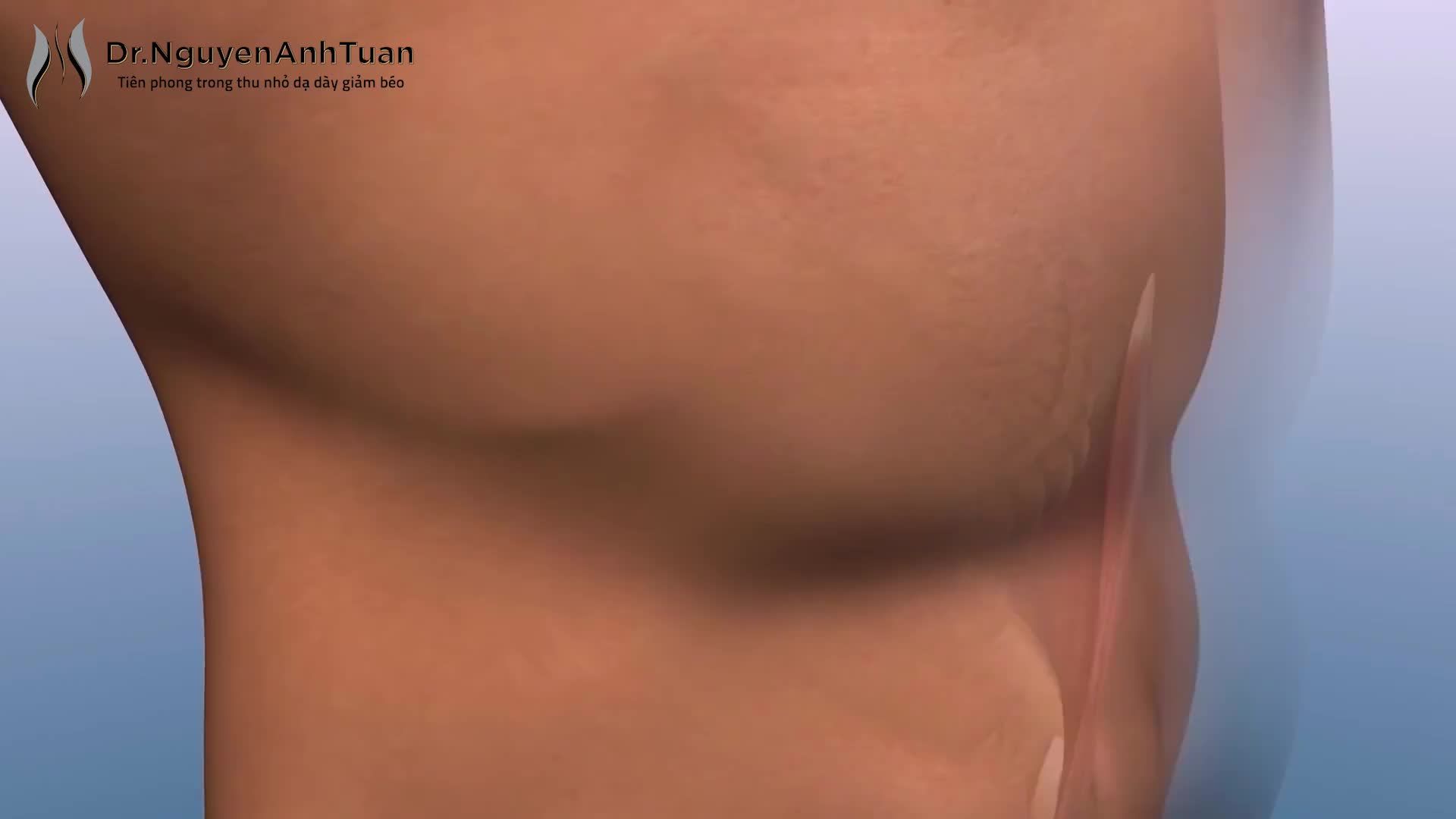 Phẫu thuật nội soi thu nhỏ dạ dày để giảm béo sẽ loại bỏ đi 70 - 80% dạ dày.