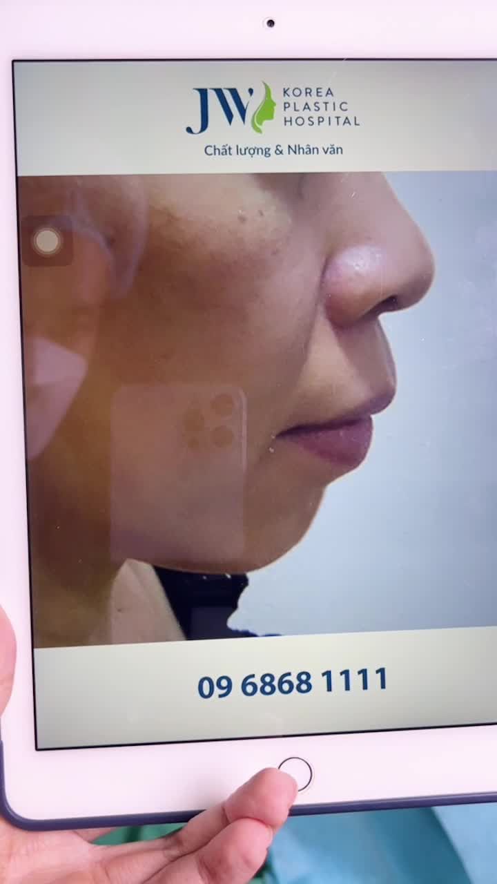 NỮ VIỆT KIỀU SỞ HỮU KHUÔN MẶT TRẺ ĐẸP, THON GỌN V LINE NHỜ COMBO TREO CHÂN MÀY + TRƯỢT CẰM TẠI JW