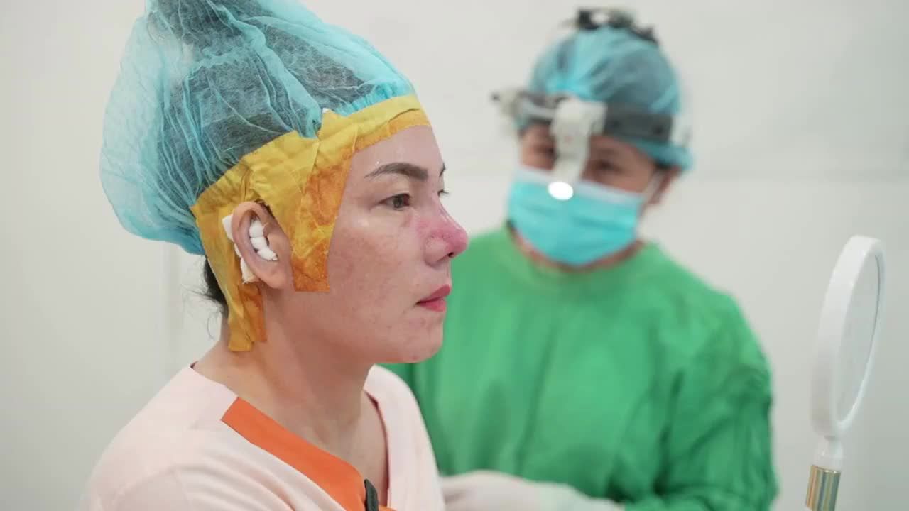 Ca nâng mũi cấu trúc sụn tai