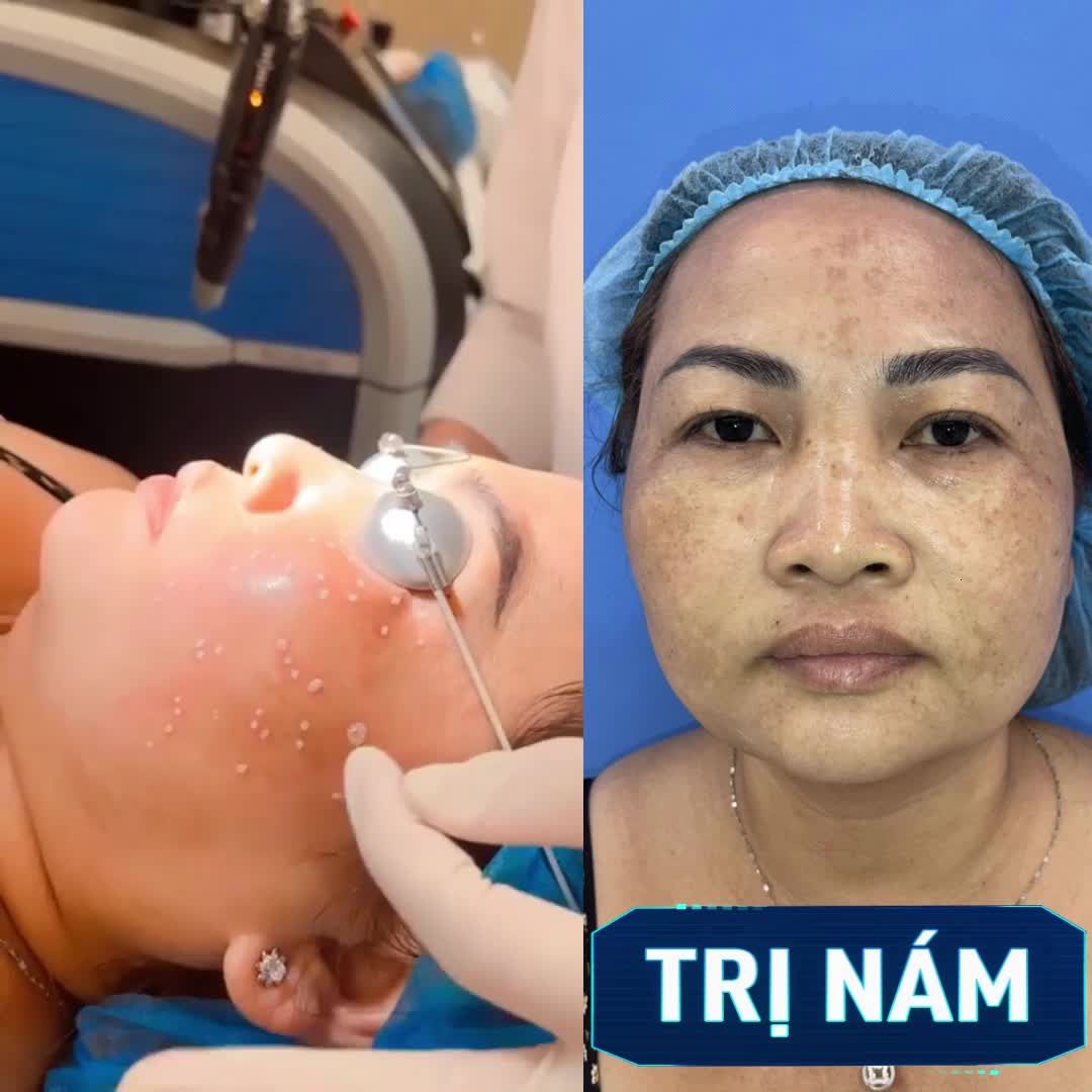 Cận cảnh làn da đang được điều trị Nám, tàn nhang phức tạp