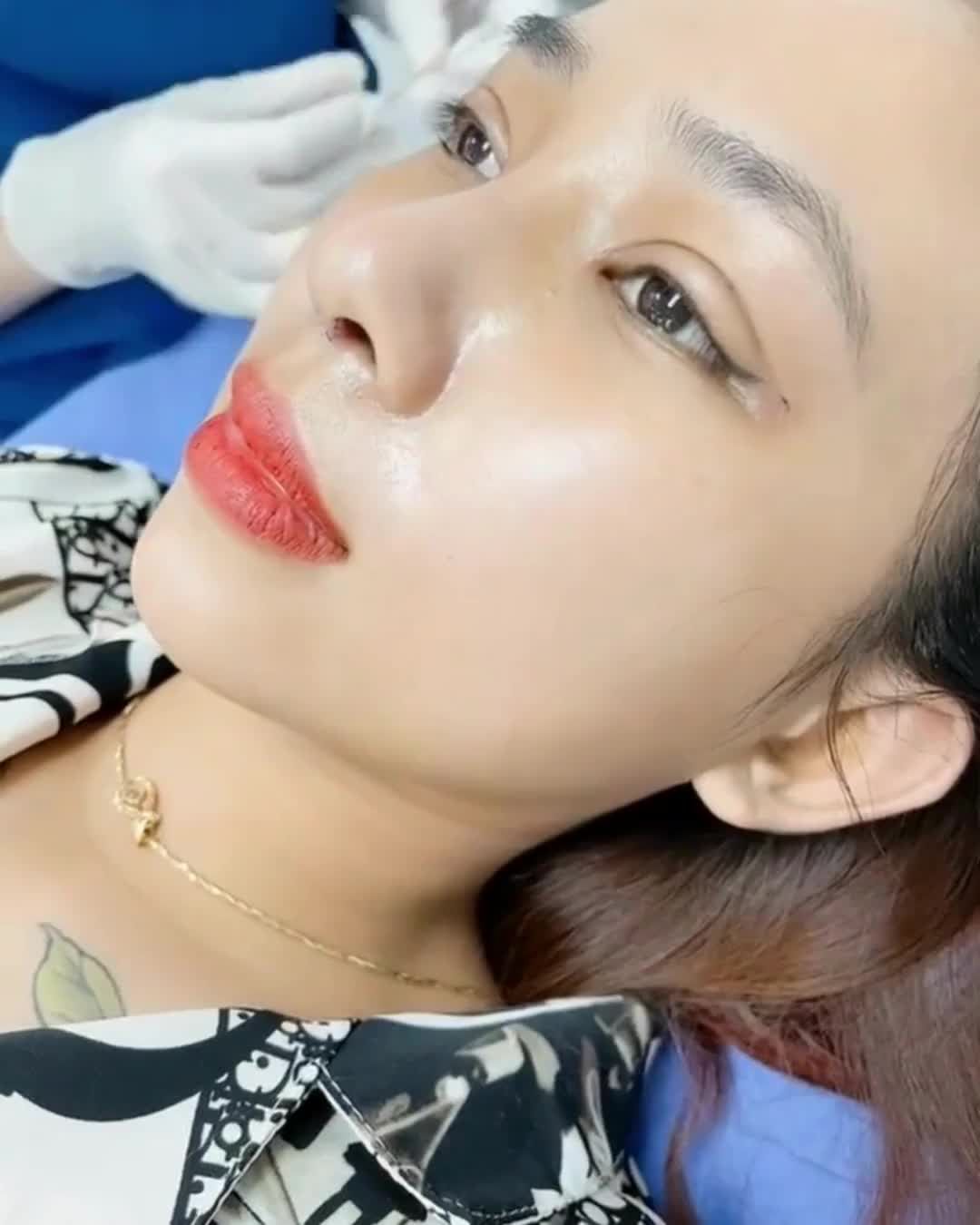 Nâng mũi 6D sau 7 ngày  Đẹp mê ly mà vô cùng tự nhiên ạaa