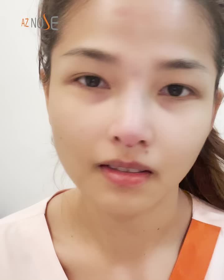 NÂNG MŨI ĐÃ THAY ĐỔI GƯƠNG MẶT HỌ THẾ NÀO