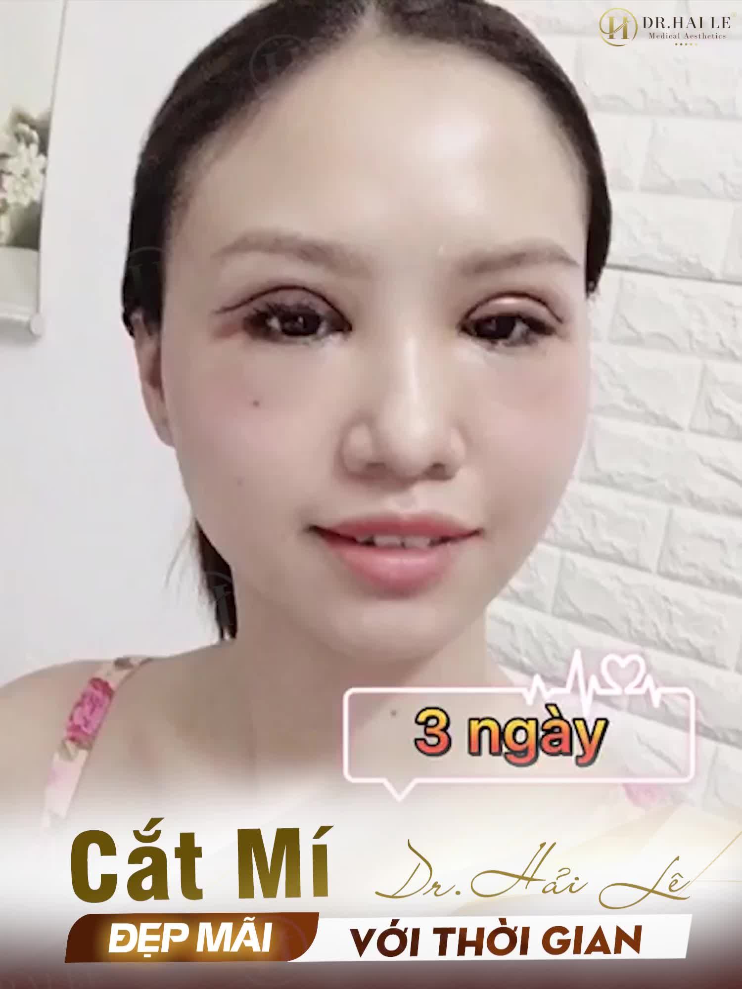 Review từ A-Z hành trình mí mắt sau 2 năm Cắt mí tại Dr.Hải Lê cơ sở HCM