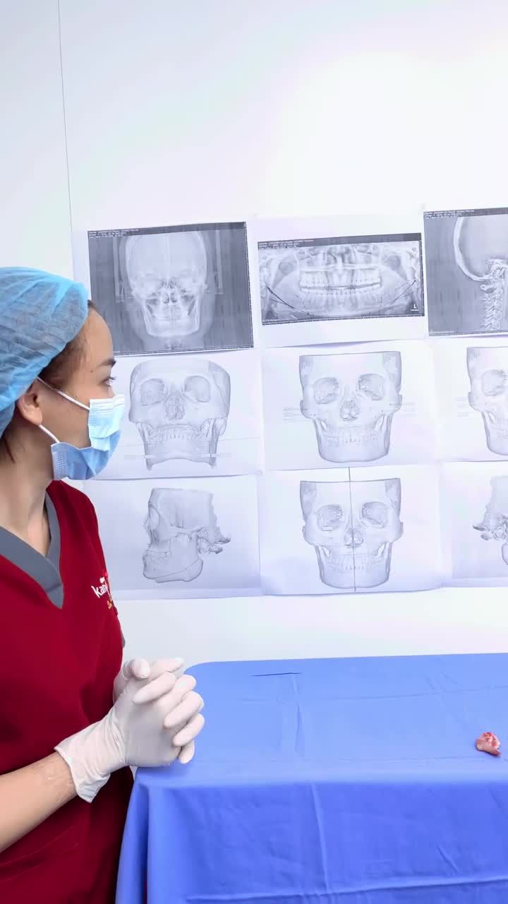 Ca hàm mặt Khó không tưởng Gọt hàm - Hạ gò má - Trượt cằm quá phát siêu lớn