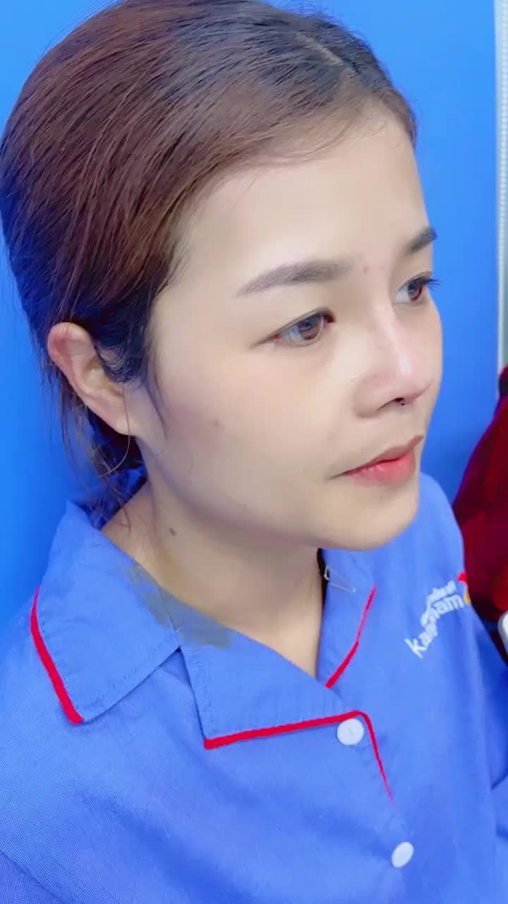 Nâng mũi 6D có thể khắc phục được những trường hợp mũi phức tạp và khó như thế nào