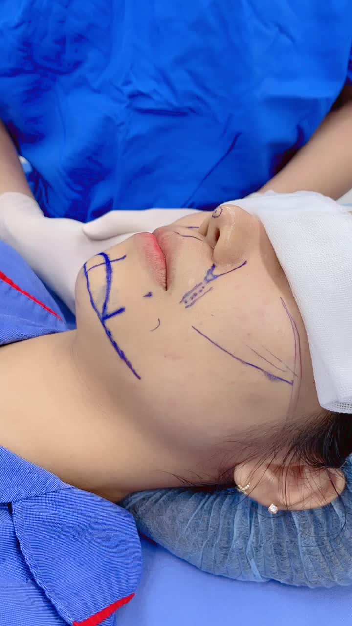 Phân tích hình ảnh thực tế của Khách hàng tiêm Botox kết hợp Filler tại Kangnam